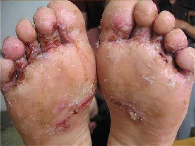 鳞屑角化型症状是足跖,足缘,足跟部皮肤脚趾增厚,粗糙,脱屑,鳞屑成