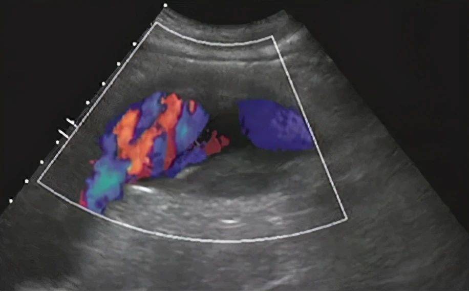 夹层|真性动脉瘤、假性动脉瘤、夹层动脉瘤特点及表现