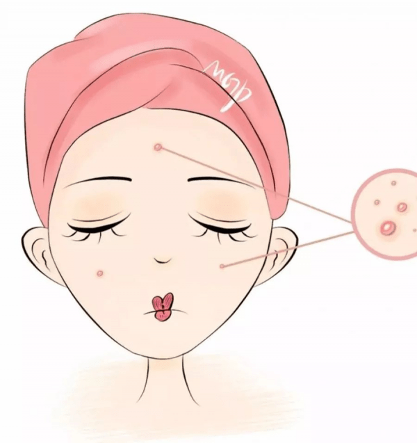 卡莎|痘痘肌的护肤分享，这样做，你也美美哒