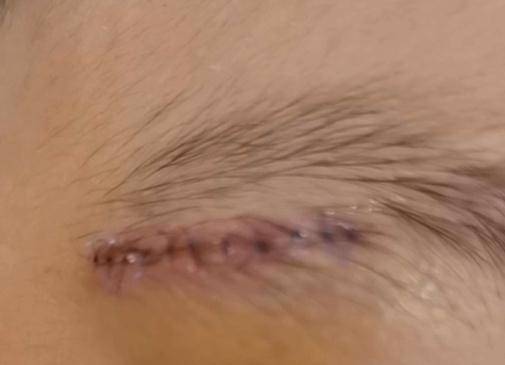 男童|贵州一4岁男童在幼儿园摔伤缝22针，家长怒索赔：少于8万免谈！