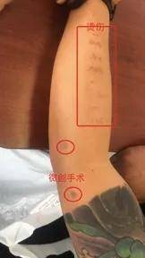 经验|担心手术后会留下疤痕？微创关节镜“小”手术解决大问题