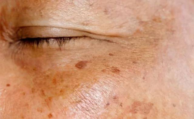 晒斑|这点没做好，脸上的斑肯定找上门