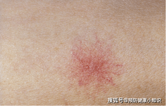 肝脏|喜欢喝酒的人,若身体有2处异常,可能是肝病要来临,不要忽视