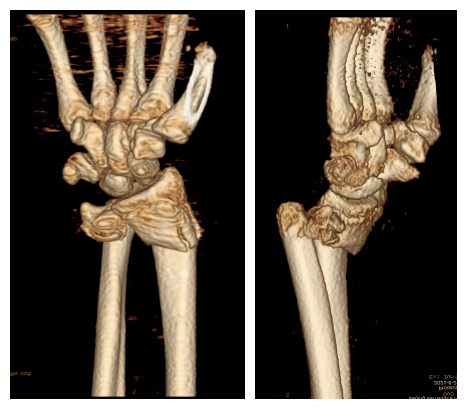 (▲術前ct三維重建)(▲術後x線片)青少年腕部骨骼仍處於發育期,嚴重