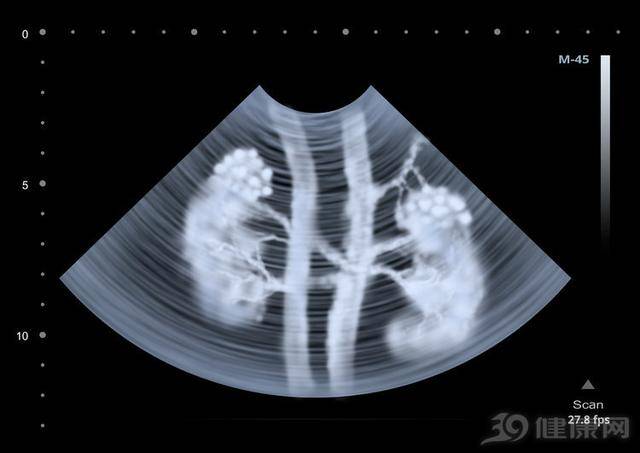 治疗|肾衰竭“刚萌芽”时，身体隐约有几个反常，别硬撑到「尿毒症」