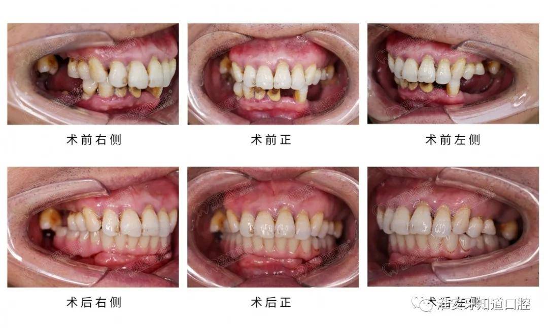 牙知道口腔种植技术院长邵弘鹏半口即刻种植案例分享