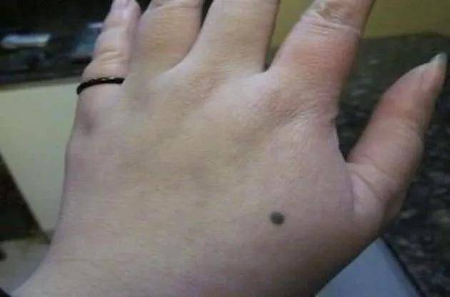 病毒|身上的瘊子是感染HPV，一个动作就会传给孩子！家里有娃的赶快看