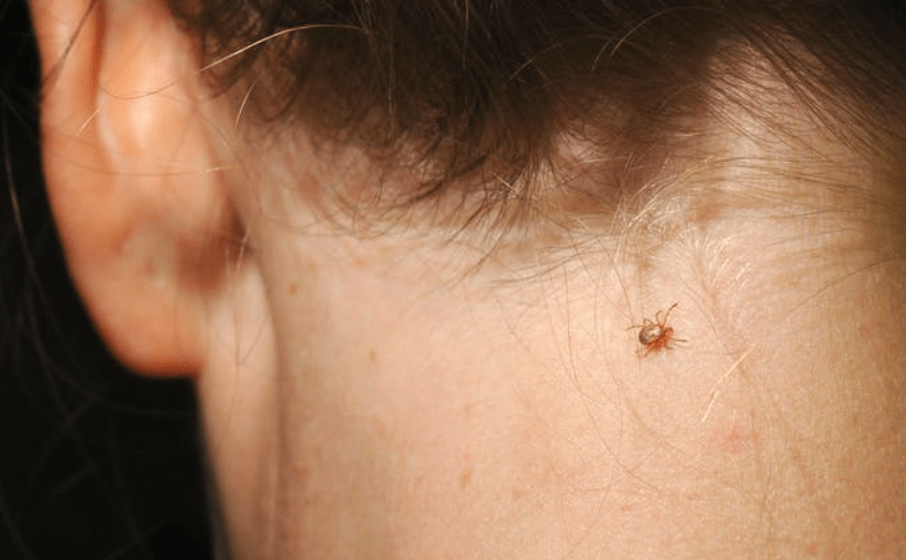 医生:蜱虫咬伤,幸亏没擅自处理_虫子