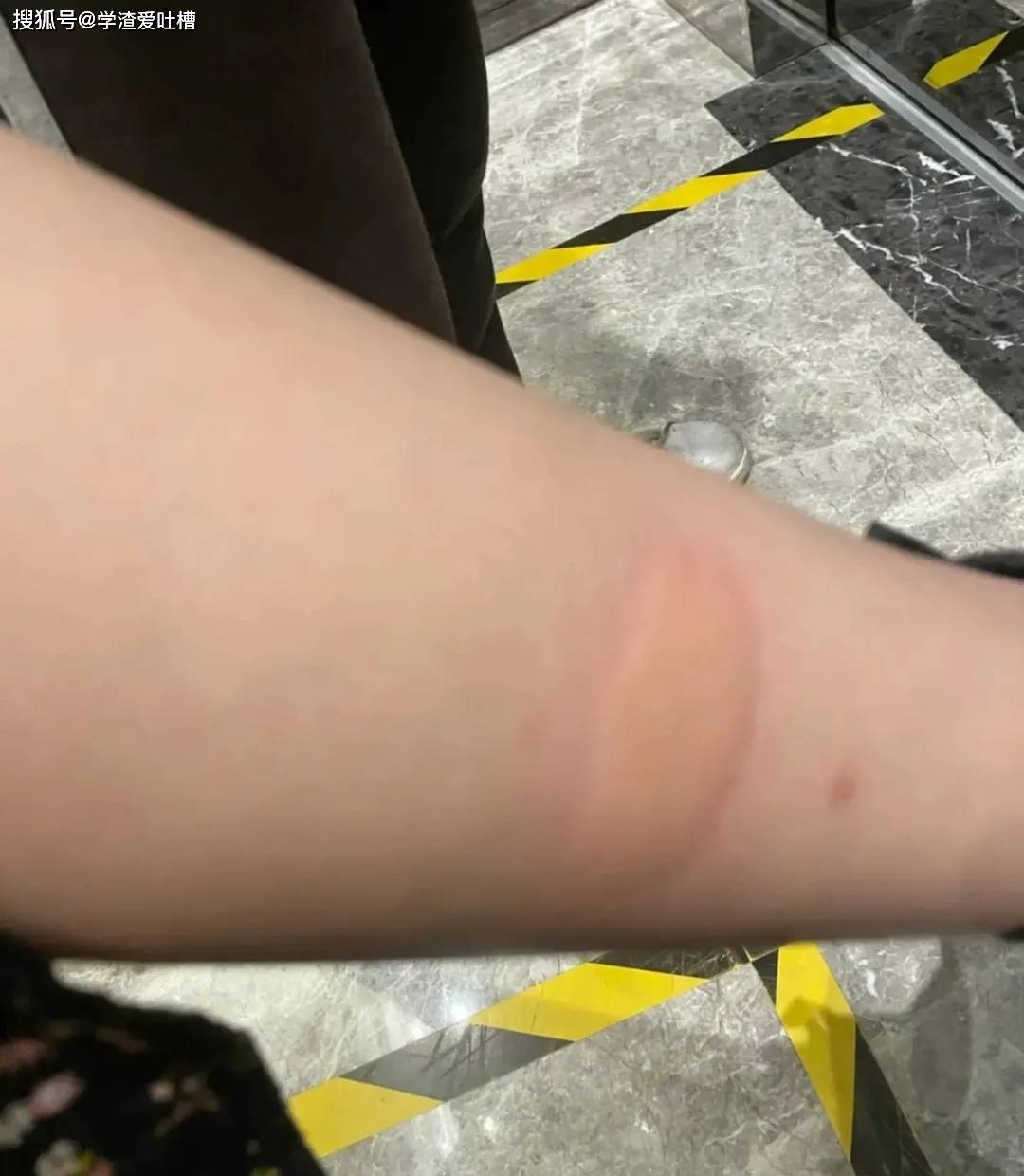 蚊子咬的包能有多离谱这些蚊子是饿疯了吧