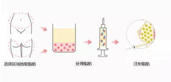 能量|面部脂肪填充维持多久？真人做过后的发言，这经必须得取！
