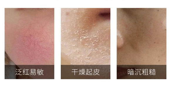 外界影响|敏感肌超爱|适合晒后修护的佰花方爽肤水，平价又好用！