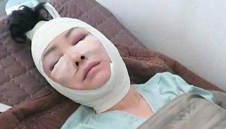 爱美|56岁大妈老来俏，贷款5万元整容，手术第二天就彻底“失控”