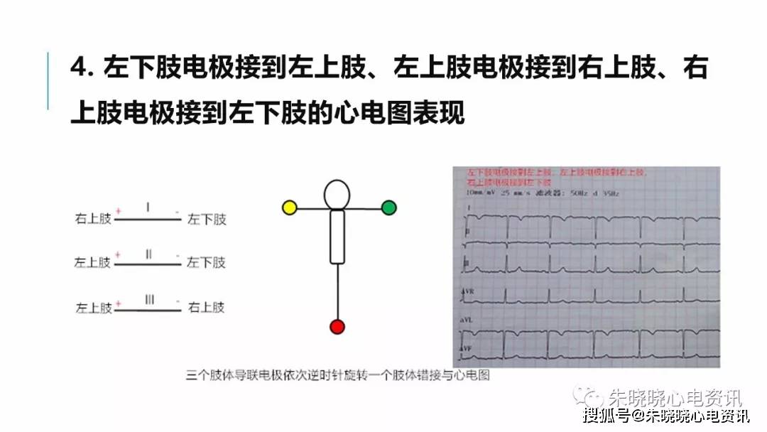 肢體導聯電極錯接心電圖分析及鑑別ppt