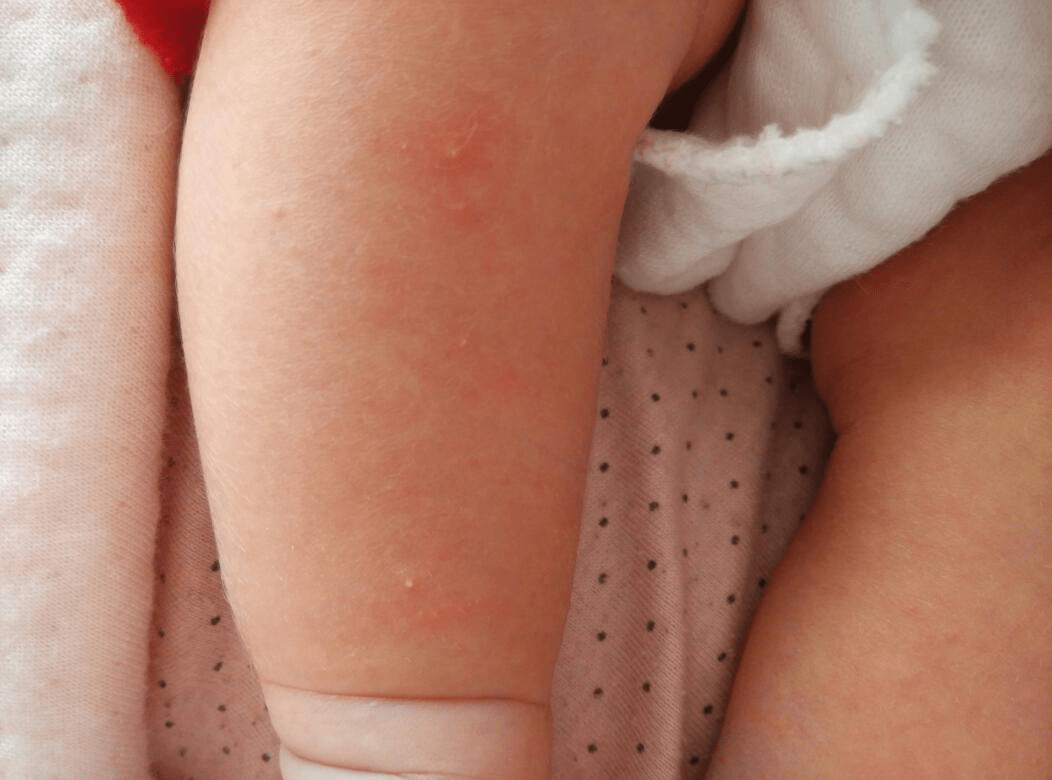 爽身粉,是因为它频繁使用后,会导致以下问题:①呼吸道问题,婴儿呼吸道