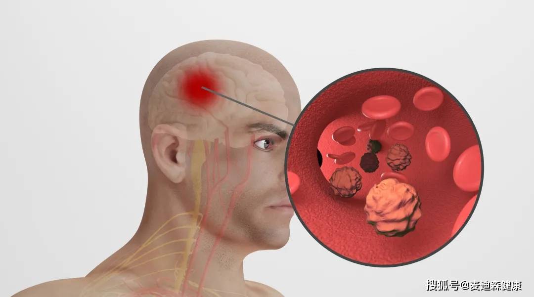 控制|麦迪森健康科普:常见的动脉瘤有几种?如何预防动脉瘤?