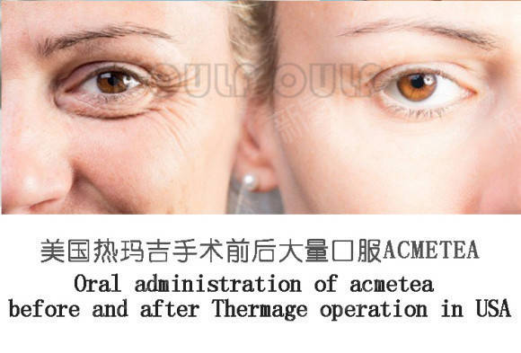 玛吉|热玛吉一个部位是什么意思？不知道的女生请围观