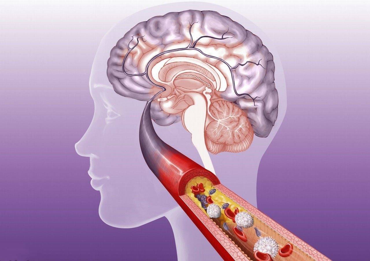 夜生活|年轻人，儿童会患脑中风吗？脑中风是否能治好，您知道吗