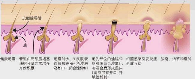 祛痘|油皮最爱的洗面奶，控油祛痘一把抓，快来看看哪款是你的菜 ？