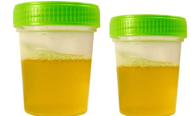 小孩|孩子身体浮肿，尿中有泡，元凶竟然是它？