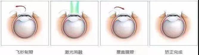 激光|普瑞眼科|“你真的了解吗” 想做近视手术先来看一看