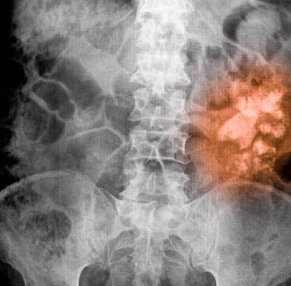 诊断|生活习惯都很规律,为什么会得肾结石。肾结石是身体内有石头吗?