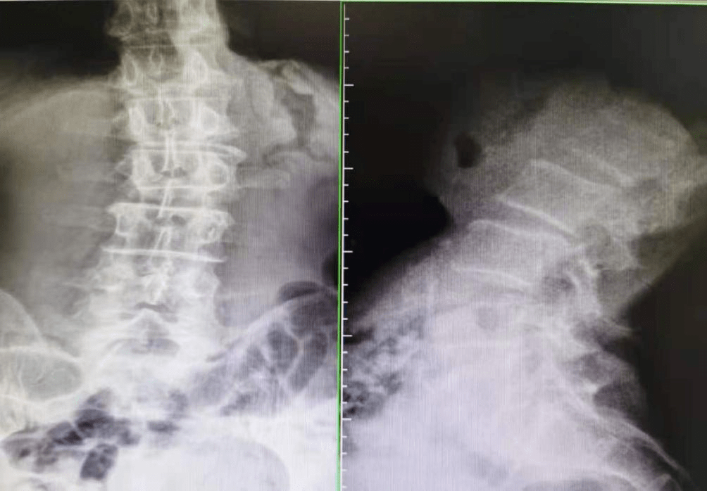 腰椎间盘|我就是擦个地 这腰怎么就坏了？