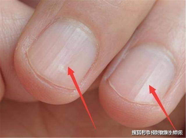 代谢|肝好的人，手上会有5个“标志”，占了一个，都要恭喜你！