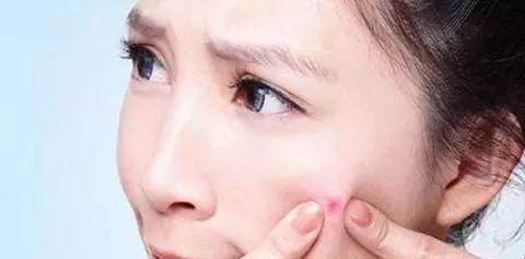 因为|毛孔粗大爱长痘痘？是否“螨虫”在作怪？要看脸上有这些感受没有