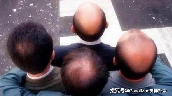 假发|地中海发型和戴假发，你更不能接受哪个？
