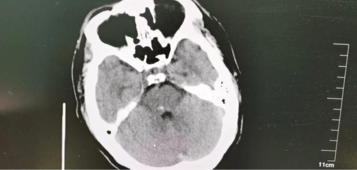 方式|46岁男子突发脑梗！医生：祸根找到了