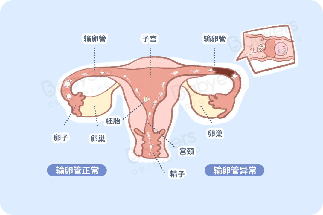 子宫|输卵管一堵，精子卵子都要哭！