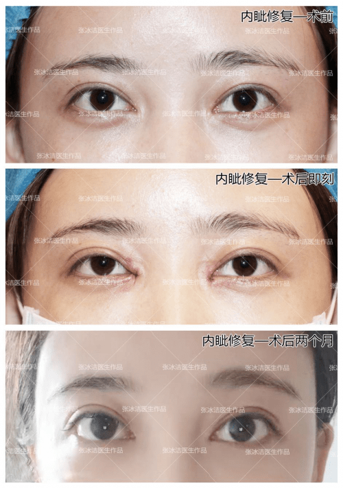 形态|张冰洁医生解析【 内眼角修复】该如何恢复皮下组织的正常“秩序”？