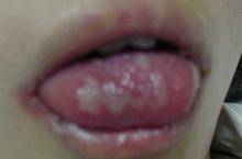 为什么会有口腔白斑 052ed283b3584149bd0db2b5bbc4fb28.jpeg