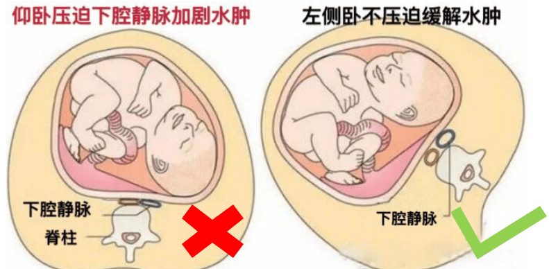 腳腫成了大豬蹄子孕期浮腫該怎麼辦