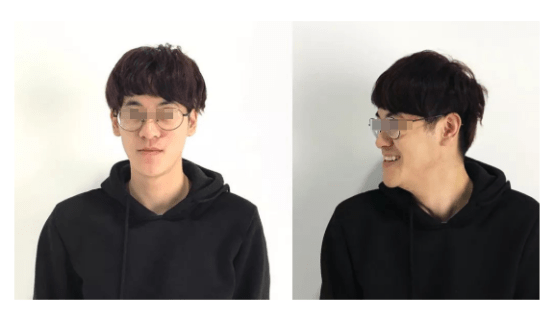 下巴|牙齿各种症状都很需要做牙齿矫正的有哪些