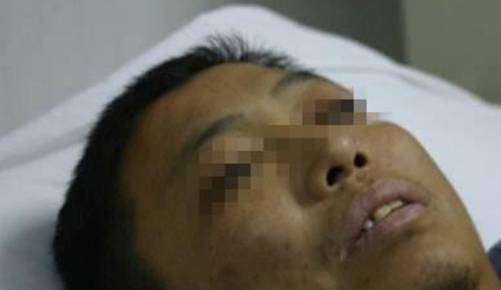 什么|误认为皮肤过敏,结果查出肝癌!提醒:皮肤4种异常或是肝癌前兆