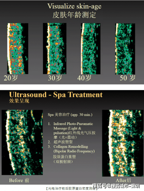 治疗|皮肤胶原流失多少，丹麦皮肤超声告诉你！