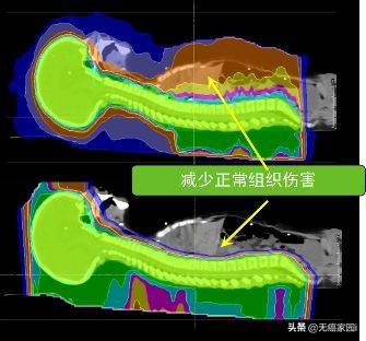 傳統放療副作用大生活質量難以保證老年兒童腫瘤患者優先考慮質子治療