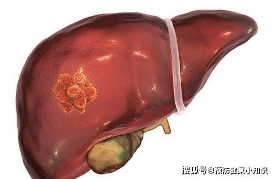 肝脏|体内有癌，肩膀先知！专家提醒：肩膀出现这一表现，或是肝癌信号