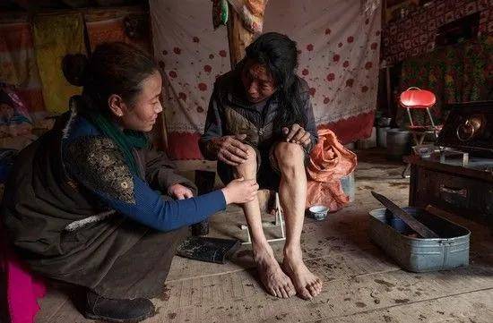 延髓|运动神经元病(渐冻症)的种类与划分