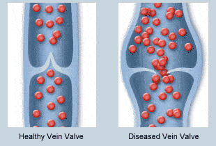 偏方|得了静脉曲张食疗就能解决吗？