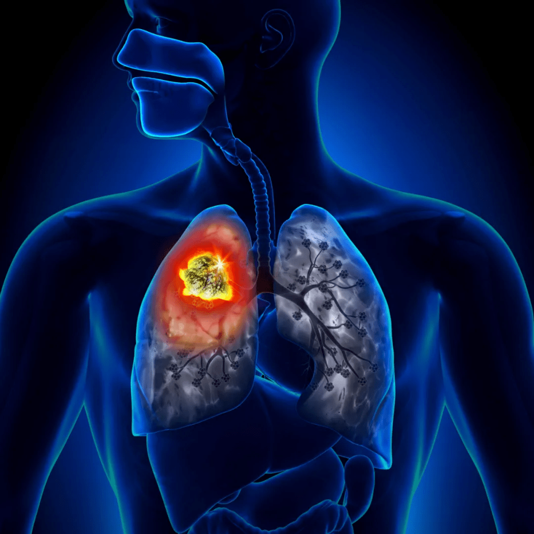 肺癌肿瘤缩小是好事吗 肺腺癌变小了