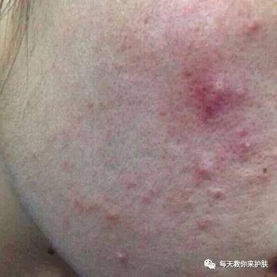 Father's|毛孔粗大，痘痘 可不止爱出油那么简单