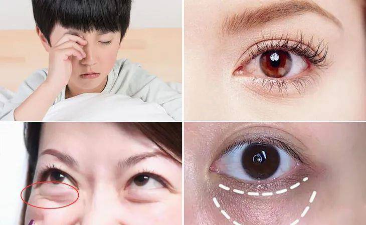 眼睛|眼部保养重在“润”！用它一喷好舒服，细纹慢慢膨了起来