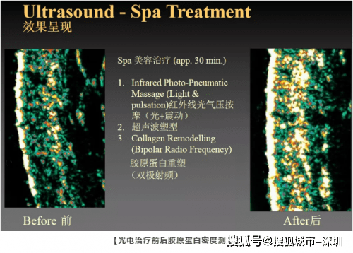 玛吉|连续做热玛吉6年，她的皮肤居然年轻了10岁！