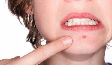 前兆|误以为皮肤过敏，查出肝硬化，提醒：皮肤这一表现或是肝病前兆