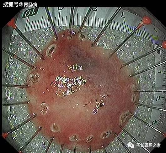 原創30歲產後20天確診胃癌沒能堅持100天如何發現早期胃癌醫生有話說