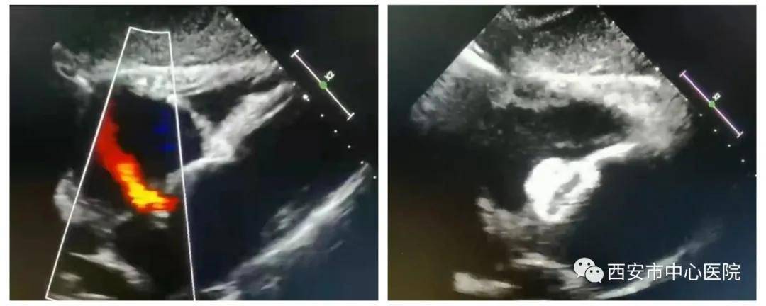 手术|一箭双雕——西安市中心医院心内科成功实施微创房间隔缺损+左心耳联合封堵术