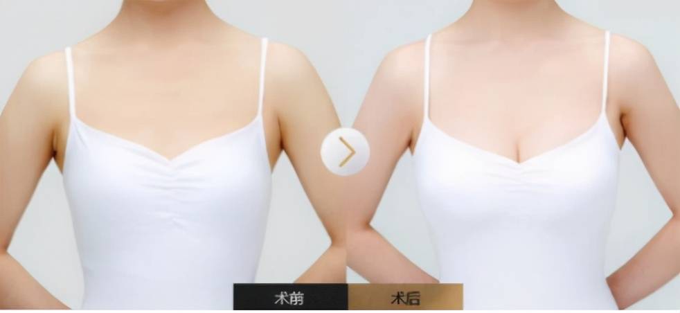 部位|实力diss：隆胸自体脂肪，抽脂隆胸的价格是多少？变美先了解！