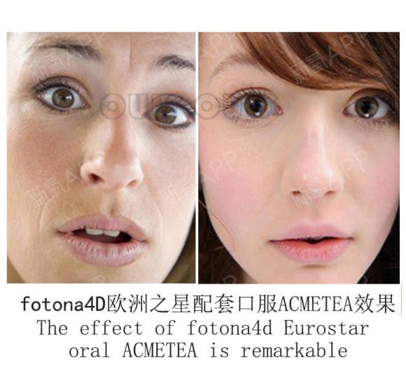 姐妹|欧洲之星fotona4d，做过的姐妹来分享下
